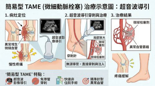 擺脫慢性痛的惡性循環：認識疼痛的「減法治療」——微細動脈栓塞 TAME