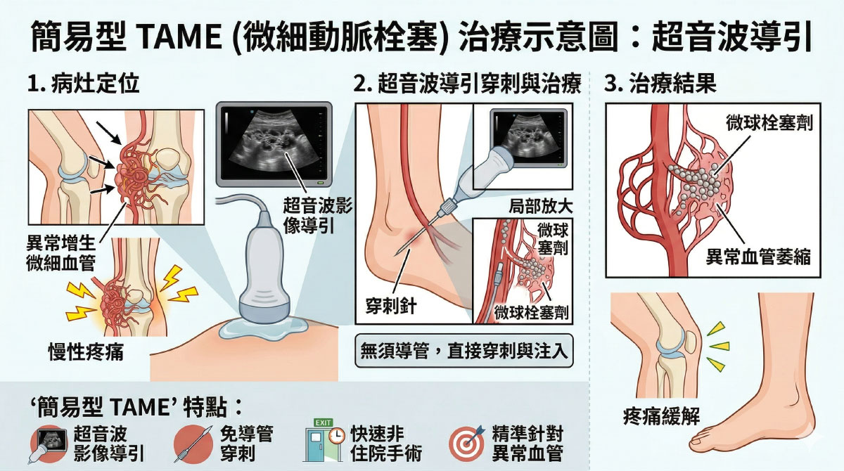 擺脫慢性痛的惡性循環：認識疼痛的「減法治療」——微細動脈栓塞 TAME